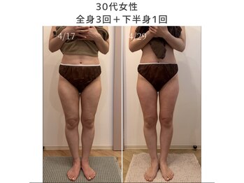 エービューティーサロン 松山店(A BEAUTY SALON.)/30代女性　下半身痩せ
