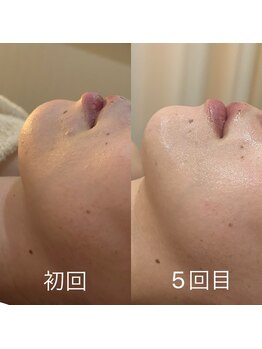 リラ 郡山店(Lilas)/肌のくすみやフェイスラインには