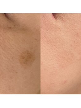 エスクリア 梅田北新地店(S.CLEAR)/月1のシミケアコース