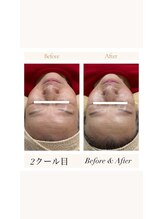 リバイセリー(Revicelly)/比較写真