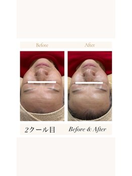 リバイセリー(Revicelly)/比較写真