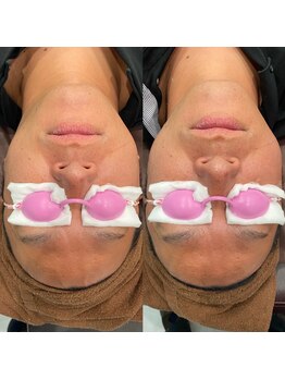 アリュール(Allure)/光フェイシャル（４０代男性）