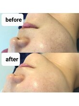 エアレ(eare)/REVl ビフォーアフター