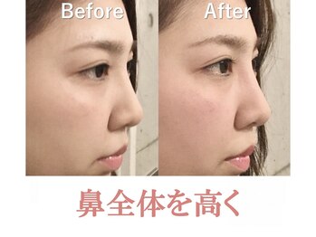 隆鼻矯正専門店 ラプリセレネ (Raplit Selene)/隆鼻+輪郭矯正(小顔)40分10回