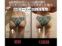 美尻研究所 福岡大名店/小尻コース＋太もも吸引