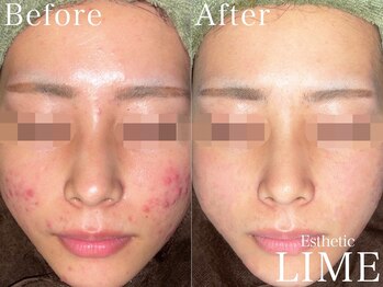 ライム 新越谷(LIME)/ハーブピーリング|ニキビケア