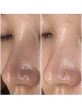 にっこりビューティー/★本気の鼻の毛穴ケア