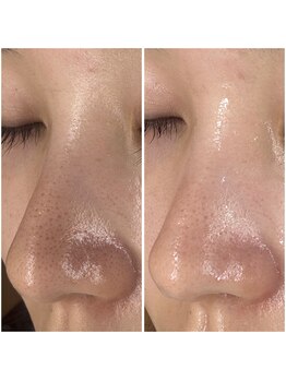 にっこりビューティー/★本気の鼻の毛穴ケア