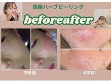 ウェリナベル(WelinaBelle)の雰囲気（天然ハーブ成分が肌に優しく働きかけ毛穴引き締めざらつき改善）