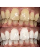 トータルビューティー エヌ プラス(total beauty n+)/Before→After プレミアムコース