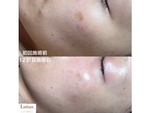 ロータス 大牟田店(Lotus.)の雰囲気（見てわかるbefre→after☆ツヤ肌目指す☆症例写真2）