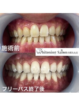 ホワイトニングサロン 京都烏丸店/ホワイトニング施術例