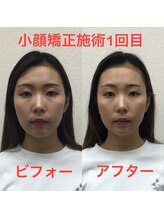 オズ六本木/六本木小顔矯正(造顔)施術1回