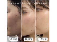 ハピネス 岡山店(Happiness)/女性大人気！小顔リフトアップ♪