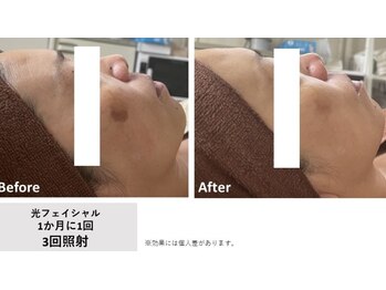 キュー(cue)/光フェイシャル