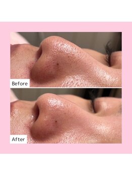 ホワイトラボ 梅田茶屋町(White labo)/【施術例】ハイドロフェイシャル