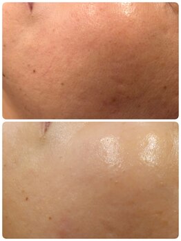 ラピスビリーブ 本店(Lapis believe)/肌質改善ハーブピーリング