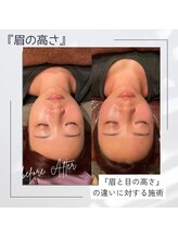 モアフェイス 池袋店(More Face)/小顔矯正　例8