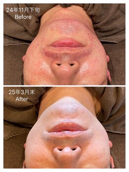 エステ シンセリティー(aesthetic sincerity)/本気の肌質改善