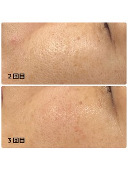 ミアローザ(Mia Rosa)/光フェイシャルで毛穴ケア