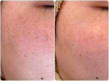 シュエット(Chouette)/韓国式ハーブピーリング