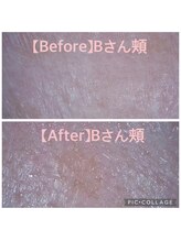 バルーサヤ 吉祥寺(Baru Saya)/Before-After Bさん頬（４０代）