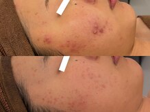 オレアグリーン 岡崎(OLEA green)の雰囲気（プラズマ×マイルドハーブでニキビに終止符/岡崎/毛穴/ハーブ）