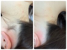 ノノ(nono)の雰囲気(アップヘアで自信を持って見せられるうなじ~襟足脱毛!)