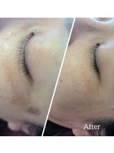 エタニティ(Eternity)/結果重視！頑固なシミも改善