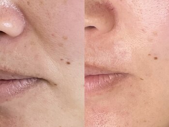 ジョワ 北堀江(joie)/ほうれい線にもポレーション導入