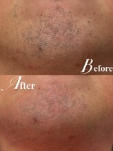 リリーミー(Rily Me)/ヒゲ脱毛