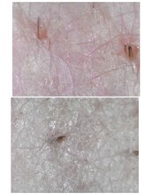 アネモネ 心斎橋院/ハーブピーリング　肌の赤み変化