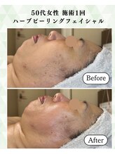 シーフェイス 横浜店(SEE FACE)/毛穴くすみケアハーブピーリング