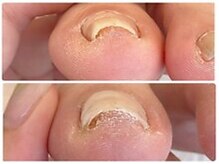 さあちゃん式フットケア アンド 巻き爪 ハンドケア アンド 深爪専門店/巻き爪ケアはお早めに！