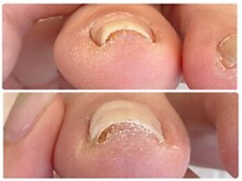 巻き爪ケアはお早めに！