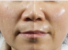 GRACETHOUSAND(グレイスサウザンド)/【韓国肌管理】ララピール