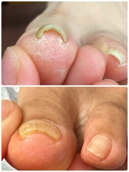 リエル(Liel)の写真/【ケア専門ネイリストによる爪育成ネイルケア】地爪を育てたい方、深爪、巻き爪・トラブルネイルにも対応☆