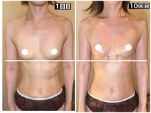 ハーズプラス(hers+)の雰囲気（バストの垂れ、ハリ、形、姿勢。全部いっしょに解決！）