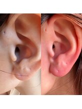 ウミ(Ummi)/ワックス　耳