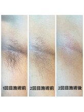 ココリ(CoCoRe)/脇MIX脱毛