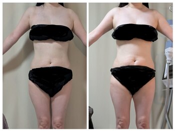 ひぺりかむ/4Dayモニター様4回目《四》