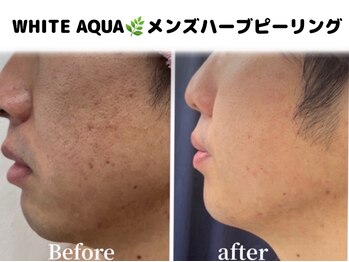ホワイトアクア 柏店(WHITE AQUA)/メンズ/ピーリング/肌質改善