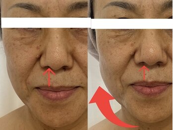 ブルーム(BLOOM)/人中短縮