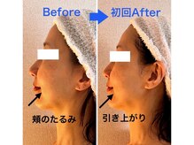 インフィニティ セルラム(INFINITY CELLULAM)/ビフォーアフター