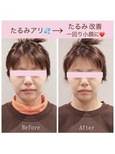 ビーホリック(Bholic)/一回り小顔、肌のハリUP