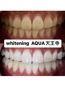 アクア 天王寺店(AQUA)/セルフホワイトニング効果