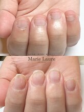 マリーロール 梅田店(Marie Laure)/自爪育成/深爪矯正/ネイルケア