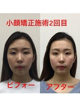 オズ六本木/六本木小顔矯正(整顔)施術2回