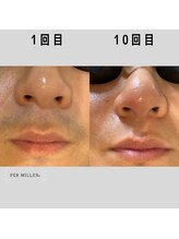 パーミル(per mille‰)/Before/After