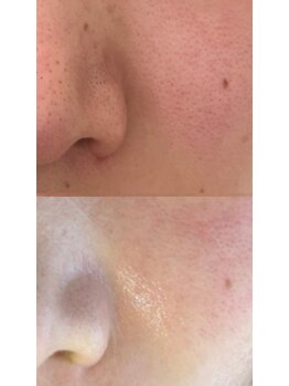 ラペカ(Lapeca)/毛穴トラブルもハーブピーリング